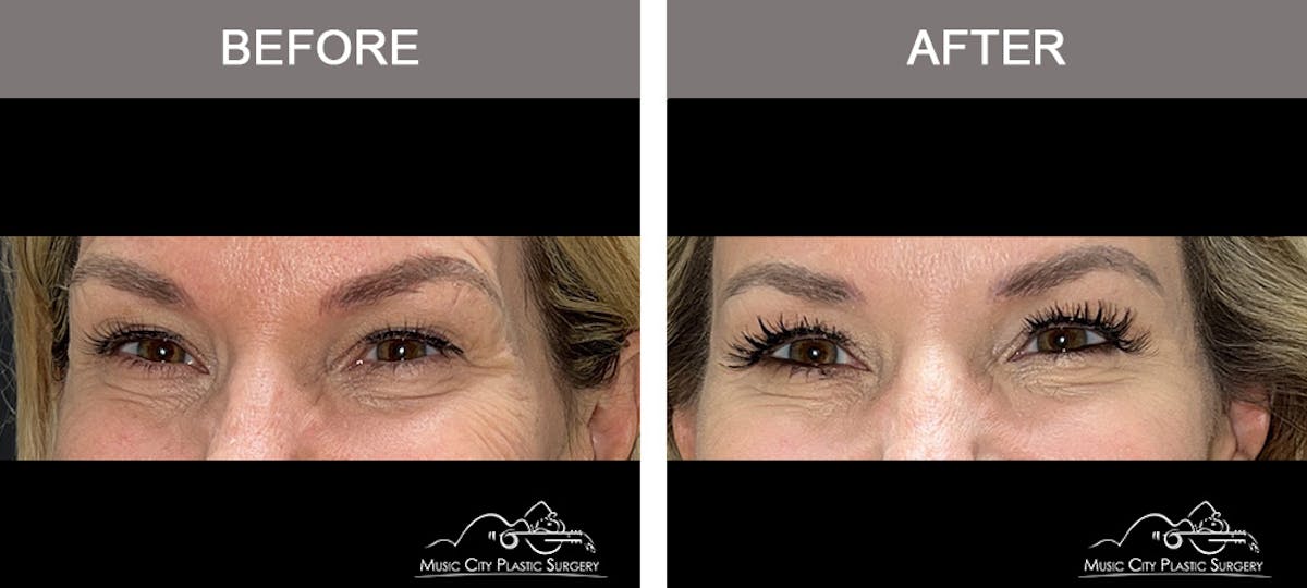 Dysport or Botox Before & After Gallery - Patient 400159 - Image 3