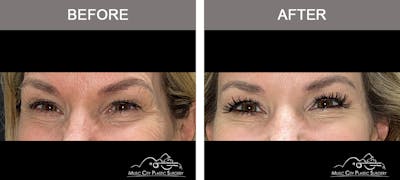 Dysport or Botox Before & After Gallery - Patient 400159 - Image 3