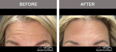 Dysport or Botox Before & After Gallery - Patient 400159 - Image 2