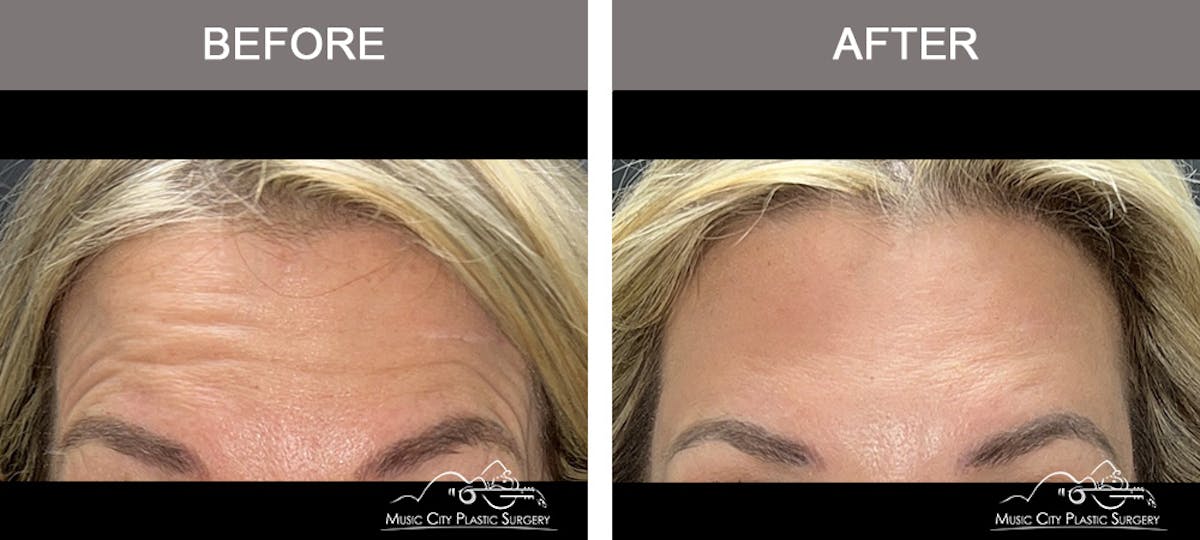 Dysport or Botox Before & After Gallery - Patient 400159 - Image 2