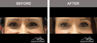 Dysport or Botox Before & After Gallery - Patient 367080 - Image 1