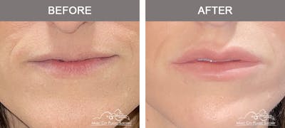 Dermal Fillers Before & After Gallery - Patient 561328 - Image 1