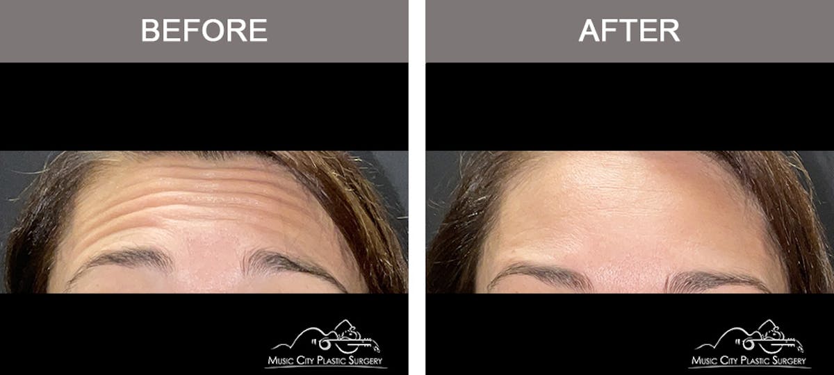 Xeomin Before & After Gallery - Patient 260470 - Image 1