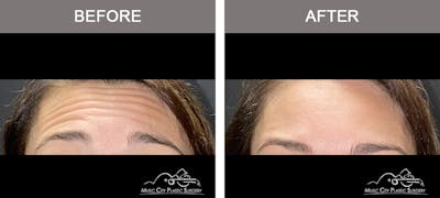 Xeomin Before & After Gallery - Patient 260470 - Image 1