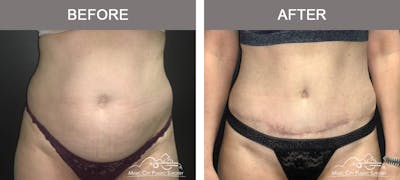 Abdominoplasty Before & After Gallery - Patient 383962 - Image 1