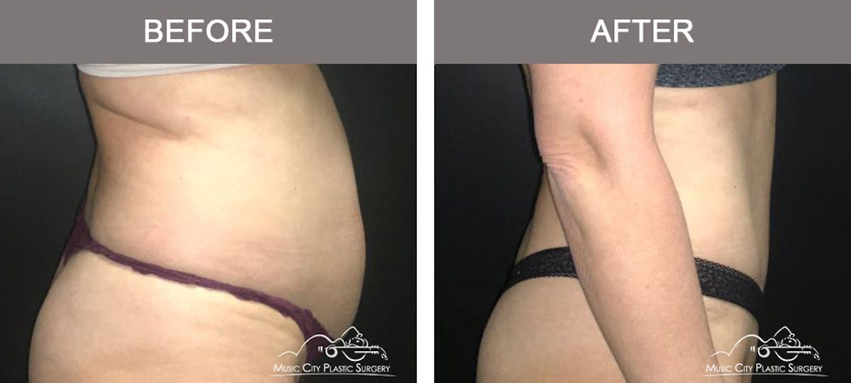 Abdominoplasty Before & After Gallery - Patient 383962 - Image 3