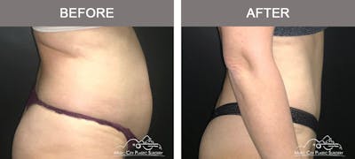 Abdominoplasty Before & After Gallery - Patient 383962 - Image 3