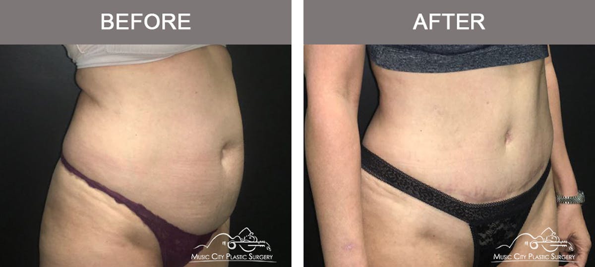 Abdominoplasty Before & After Gallery - Patient 383962 - Image 2