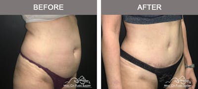 Abdominoplasty Before & After Gallery - Patient 383962 - Image 2