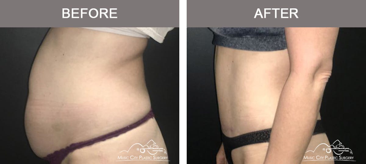 Abdominoplasty Before & After Gallery - Patient 383962 - Image 5