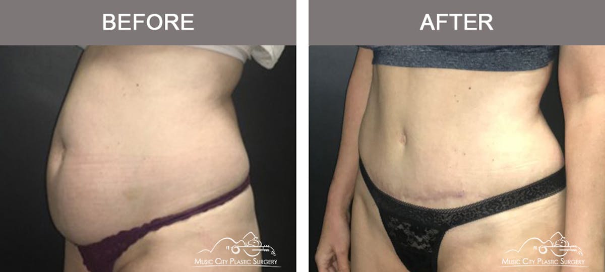 Abdominoplasty Before & After Gallery - Patient 383962 - Image 4