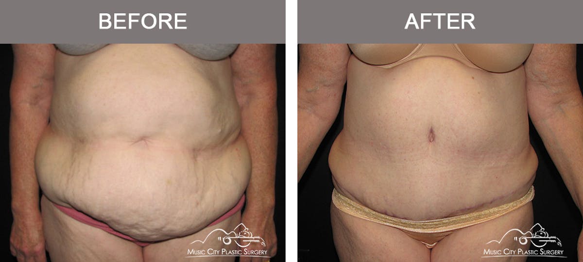 Abdominoplasty Before & After Gallery - Patient 379562 - Image 1