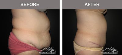 Abdominoplasty Before & After Gallery - Patient 379562 - Image 3