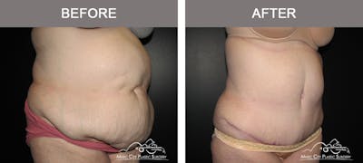 Abdominoplasty Before & After Gallery - Patient 379562 - Image 2
