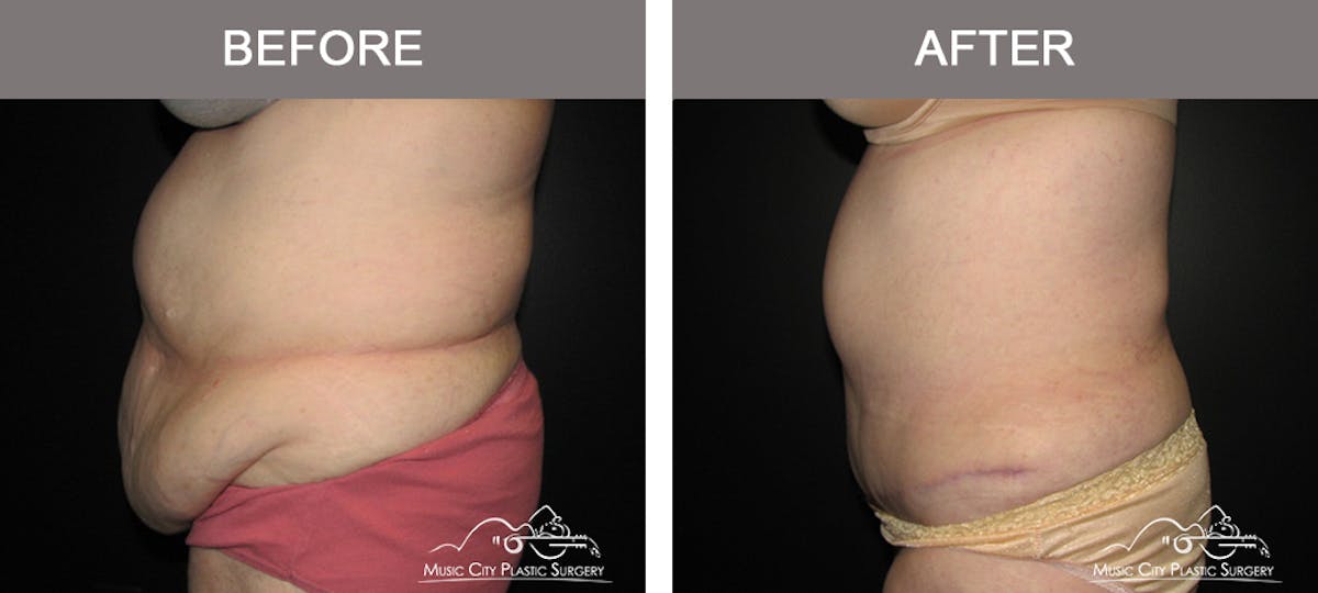 Abdominoplasty Before & After Gallery - Patient 379562 - Image 5
