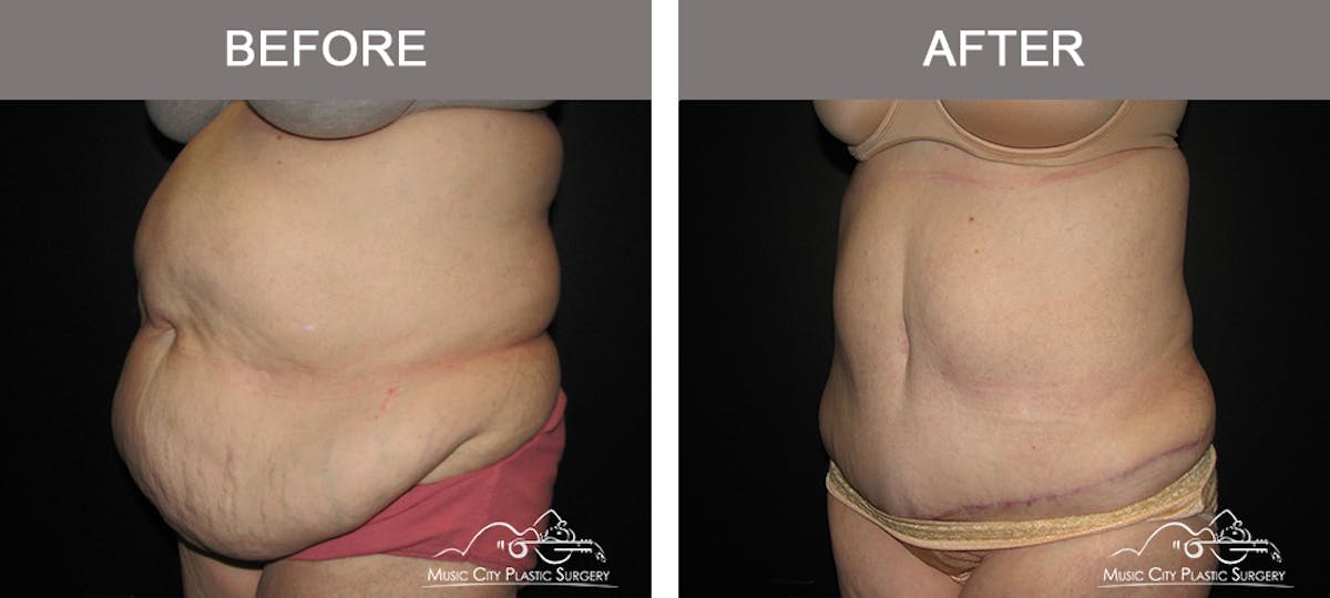 Abdominoplasty Before & After Gallery - Patient 379562 - Image 4