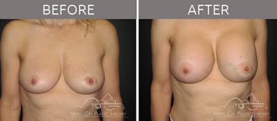 Breast Lift with Augmentation Before & After Gallery - Patient 414053 - Image 1