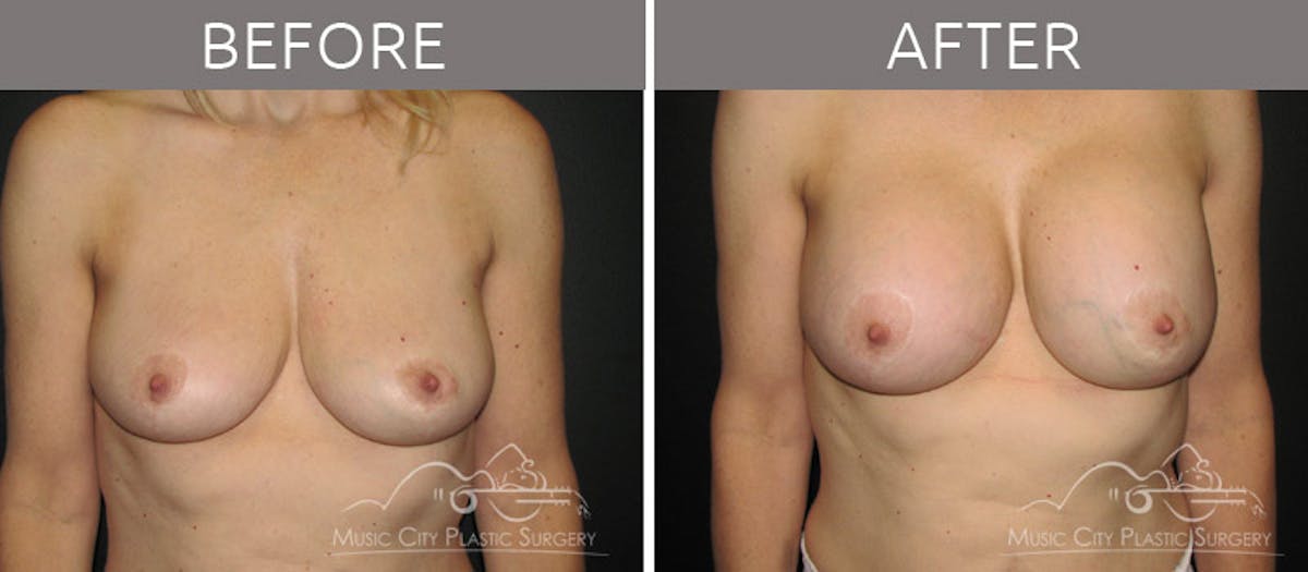 Breast Augmentation Before & After Gallery - Patient 715572 - Image 1