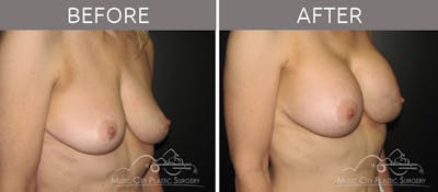 Breast Augmentation Before & After Gallery - Patient 715572 - Image 2