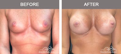 Breast Augmentation Before & After Gallery - Patient 311048 - Image 1