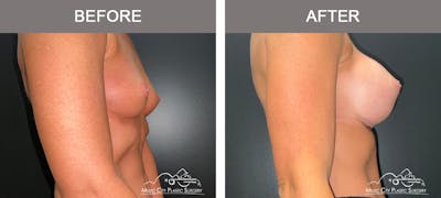 Breast Augmentation Before & After Gallery - Patient 311048 - Image 3
