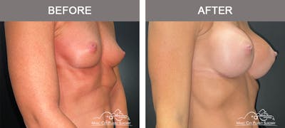 Breast Augmentation Before & After Gallery - Patient 311048 - Image 2