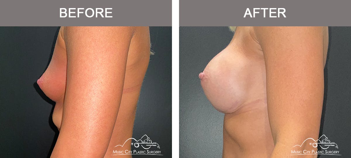Breast Augmentation Before & After Gallery - Patient 311048 - Image 5