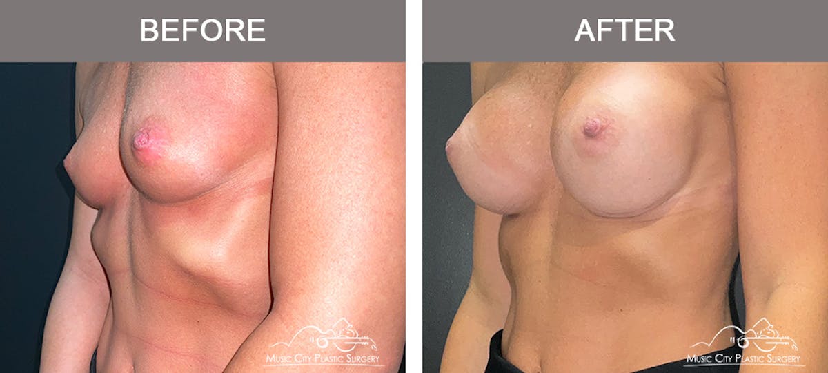 Breast Augmentation Before & After Gallery - Patient 311048 - Image 4
