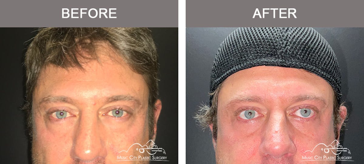 Blepharoplasty Before & After Gallery - Patient 138944 - Image 1