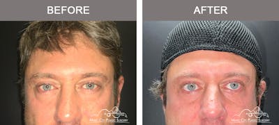 Blepharoplasty Before & After Gallery - Patient 138944 - Image 1