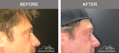 Blepharoplasty Before & After Gallery - Patient 138944 - Image 3