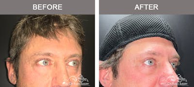 Blepharoplasty Before & After Gallery - Patient 138944 - Image 2