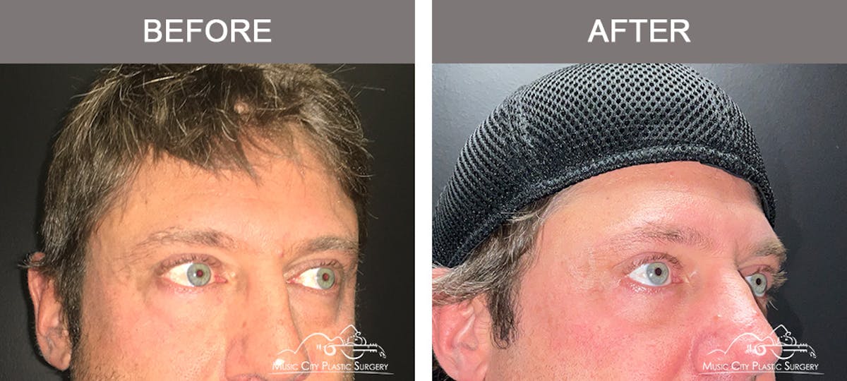 Blepharoplasty Before & After Gallery - Patient 138944 - Image 2