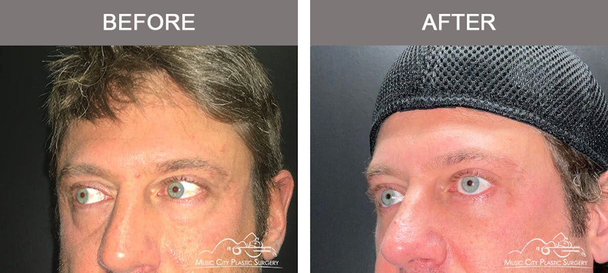 Blepharoplasty Before & After Gallery - Patient 138944 - Image 4