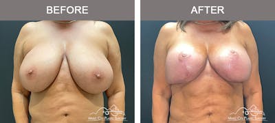 Breast Lift Before & After Gallery - Patient 383636 - Image 1