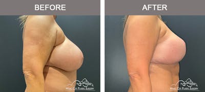 Breast Lift Before & After Gallery - Patient 383636 - Image 3