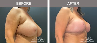 Breast Lift Before & After Gallery - Patient 383636 - Image 2