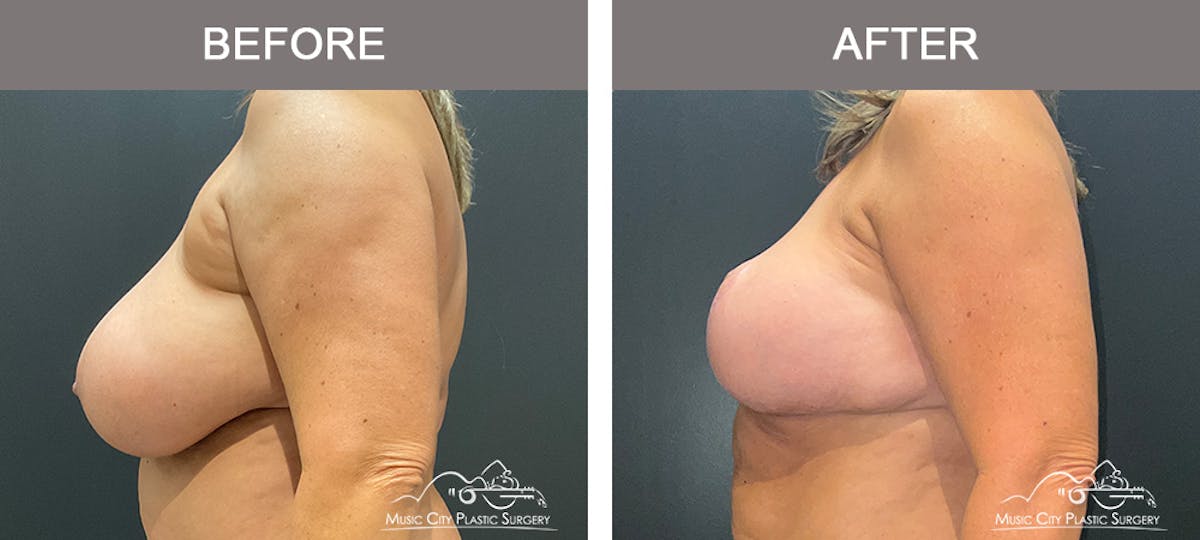 Breast Lift Before & After Gallery - Patient 383636 - Image 5