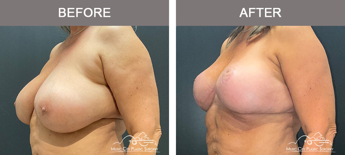 Breast Lift Before & After Gallery - Patient 383636 - Image 4