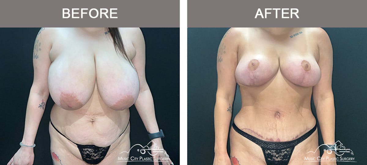 Breast Lift Before & After Gallery - Patient 677756 - Image 1