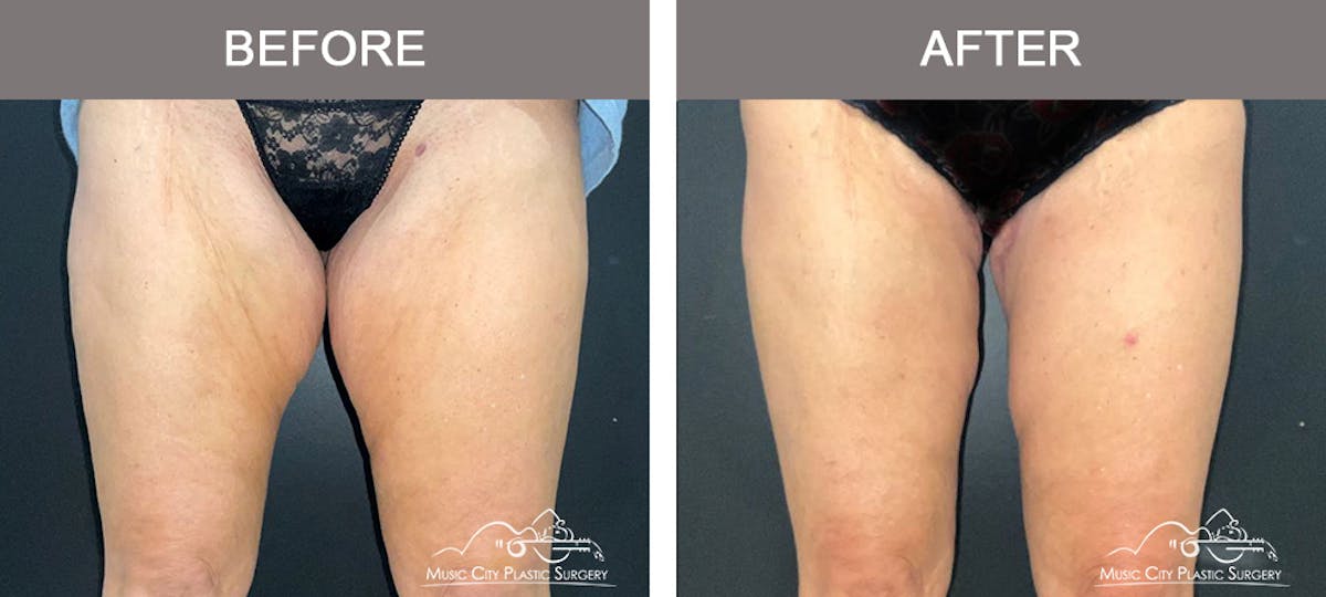 Thighplasty Before & After Gallery - Patient 126284 - Image 1
