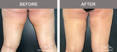 Thighplasty Before & After Gallery - Patient 126284 - Image 2