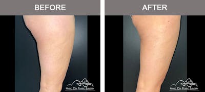 Thighplasty Before & After Gallery - Patient 126284 - Image 3