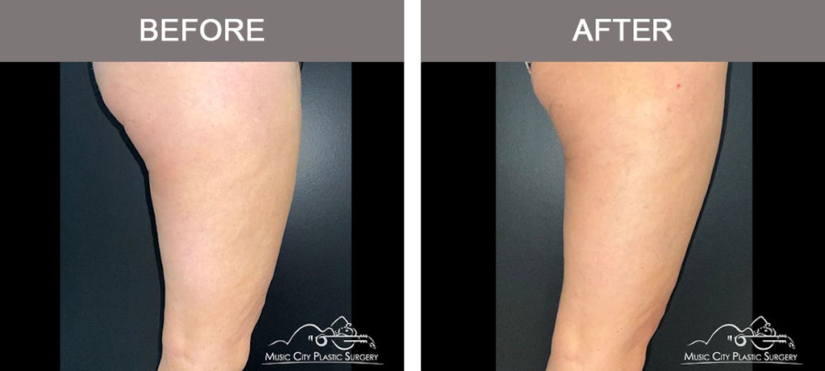 Thighplasty Before & After Gallery - Patient 126284 - Image 3