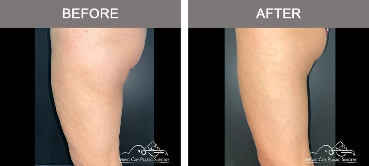Thighplasty Before & After Gallery - Patient 126284 - Image 4
