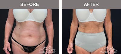 Weight Loss Injections Before & After Gallery - Patient 396510 - Image 1