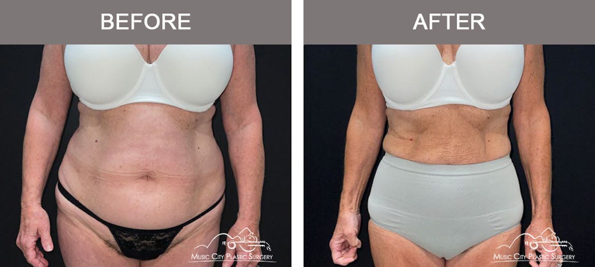 Semaglutide Before & After Gallery - Patient 396510 - Image 1