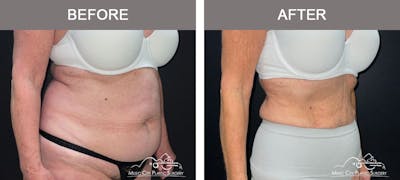 Semaglutide Before & After Gallery - Patient 396510 - Image 2