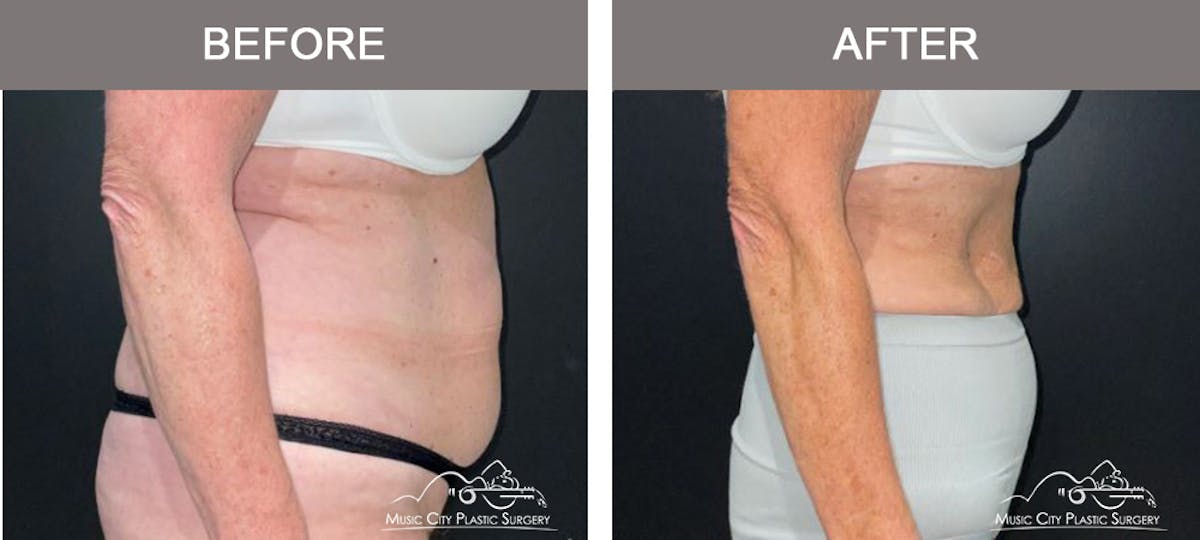 Weight Loss Injections Before & After Gallery - Patient 396510 - Image 3