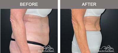 Semaglutide Before & After Gallery - Patient 396510 - Image 3